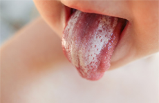 Tongue of a toddler with white plaque